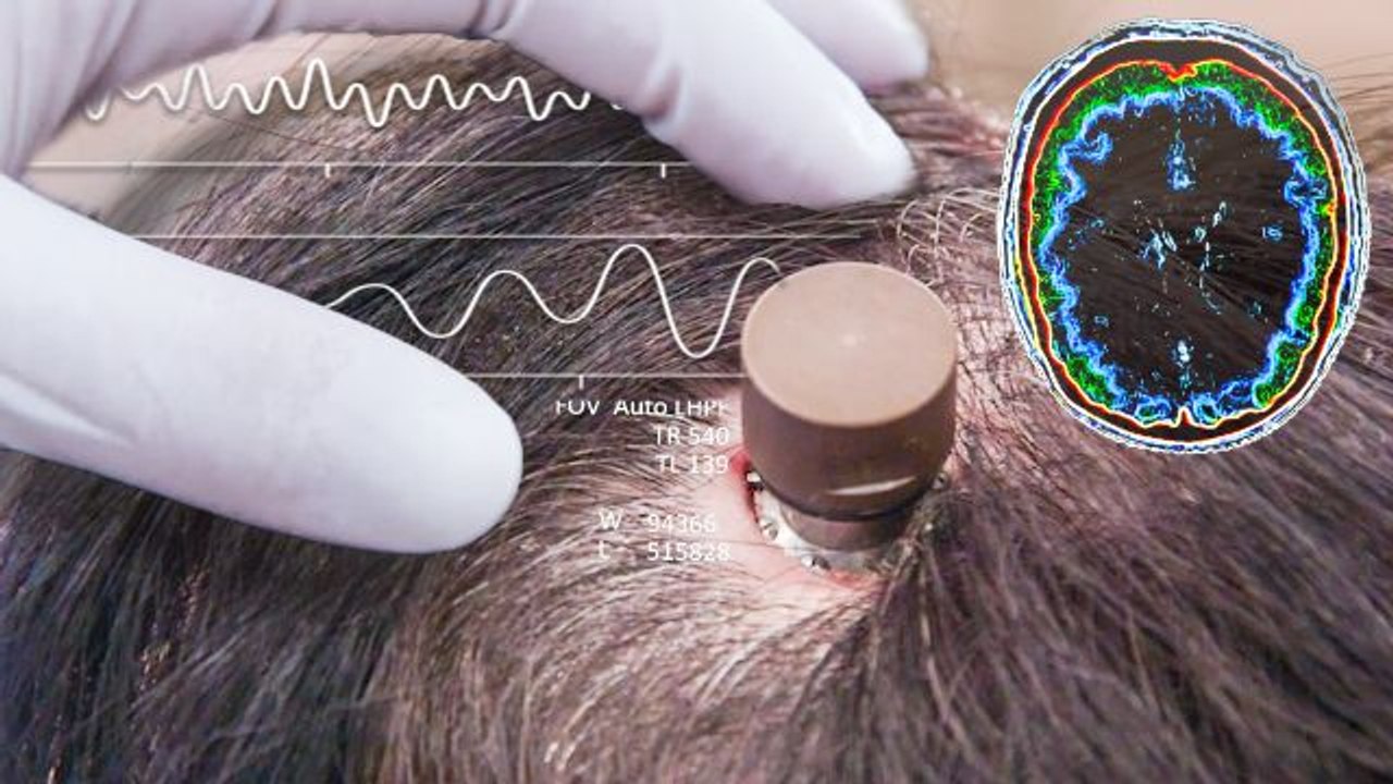The Science Behind Elon Musk’s Neuralink Brain Chip