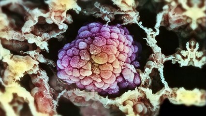 Krebs - Eine Biografie: Der Herrscher aller Krankheiten Trailer DF