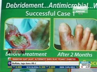 Guna ulat lalat bantu pesakit diabetes