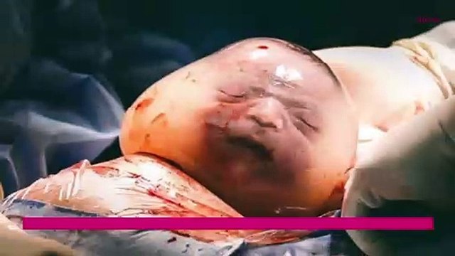 Bébé sirène : quel est ce phénomène rare qui touche certains nouveau-nés ?