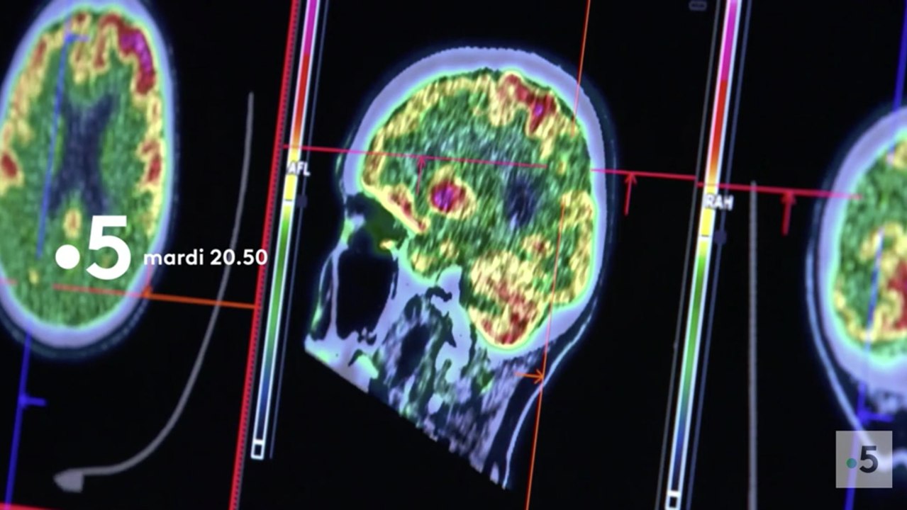Enquête de santé (france 5) Alzheimer comment lutter contre la maladie