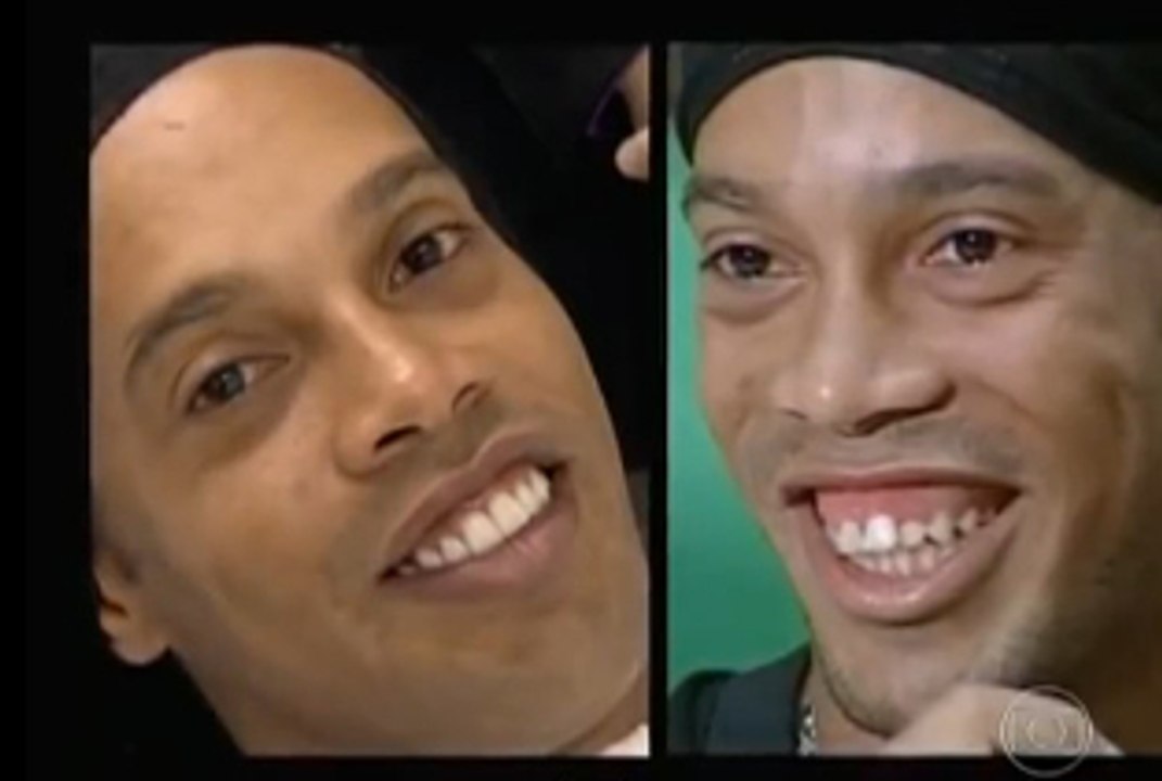 Insolite : Les nouvelles dents de Ronaldinho