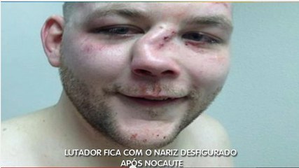 MMA : Une fracture du nez impressionnante de Andy Eichholz après un combat