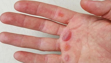 खूनी छाले पड़ने पर न घबराए, इन देसी उपायों को अजमाएं l Boldsky