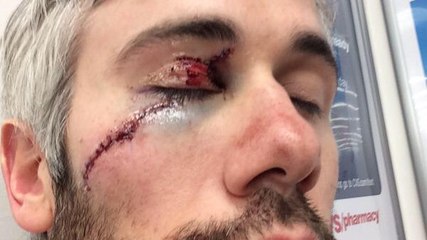 Un hockeyeur se fait défigurer par un coup de patin