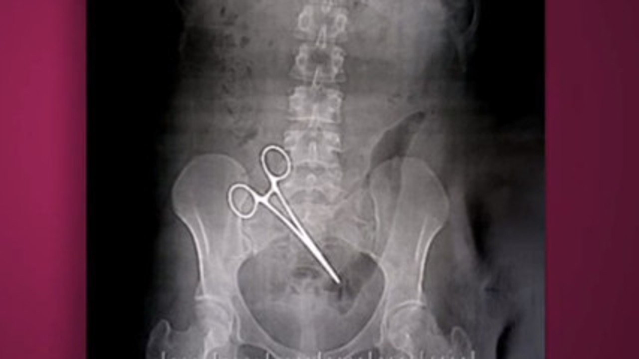 Suite à une opération, une jeune femme passe 5 mois avec une pince de 15 cm dans le ventre