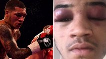 Conor Benn gagne son combat mais en ressort le visage complètement ravagé