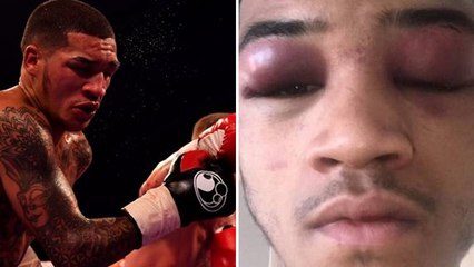 Conor Benn gagne son combat mais en ressort le visage complètement ravagé