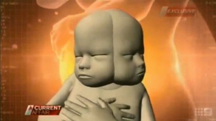 Renee et Simon Howie vont devenir parents d'un bébé à deux têtes