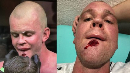 UFC Hambourg : Stefan Struve termine son combat contre Marcin Tybura avec une énorme entaille au menton