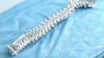 Des médecins soignent une scoliose grâce à une imprimante 3D