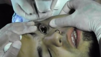 Il décide de se faire tatouer l'œil tout en noir