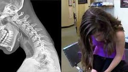 Quand les smartphones provoquent des problèmes de cou très douloureux