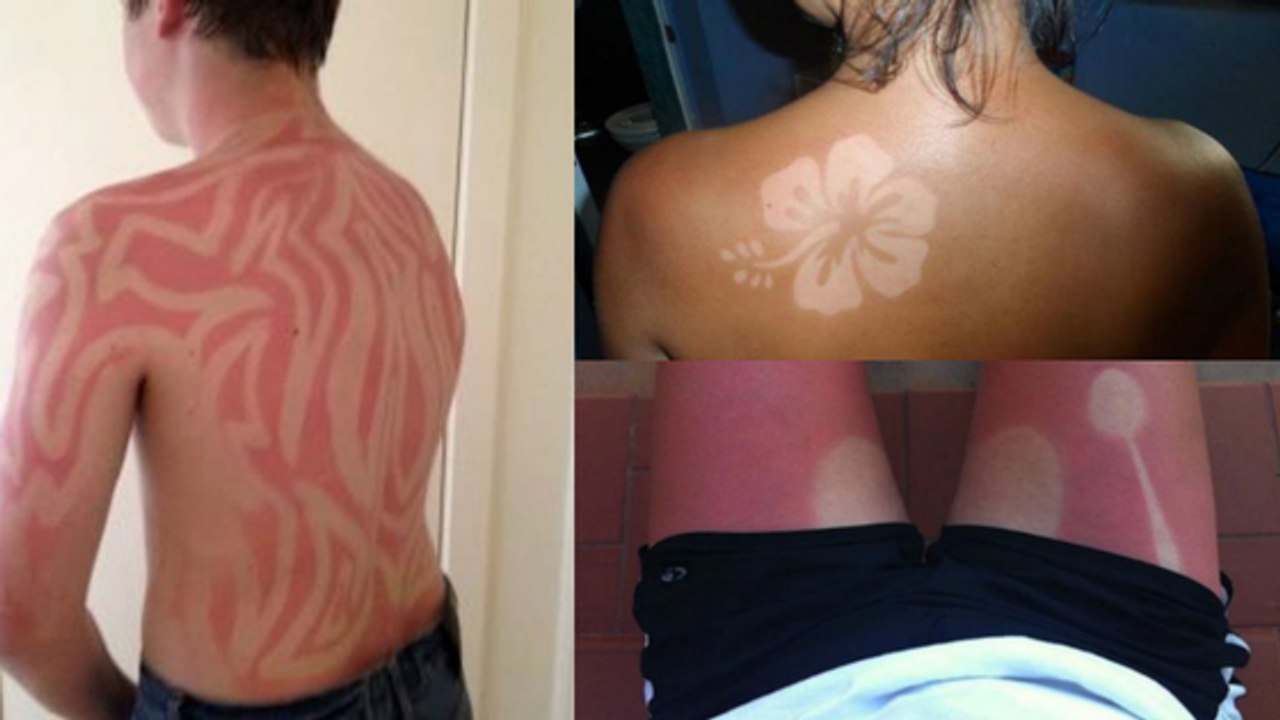 SunburnArt : le nouveau phénomène de mode dangereux pour la santé