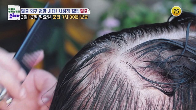 탈모 인구 천만 시대! 사회적 질병 탈모_내 몸을 살리는 유레카 56회 예고 TV CHOSUN 220313 방송