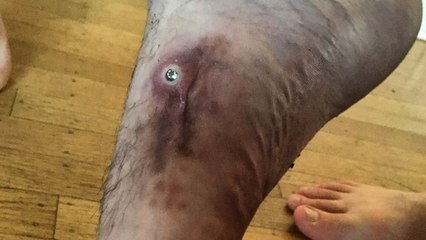 Après une opération chirurgicale, une vis sort de son pied !