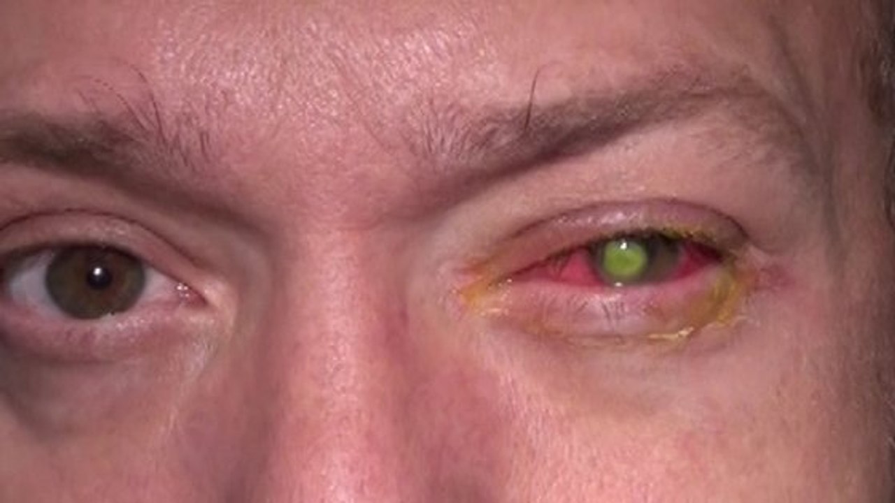 Cet homme devient aveugle à cause d'un petit oubli