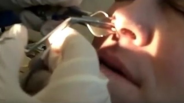 Un médecin retire quelque chose de dégoûtant du nez d'un patient