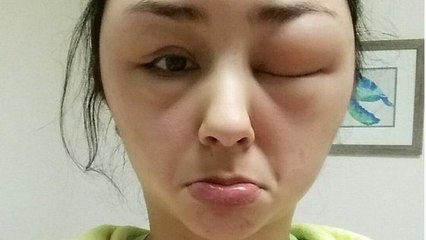 Après avoir utilisé une teinture pour cheveux, son visage s'est complètement déformé