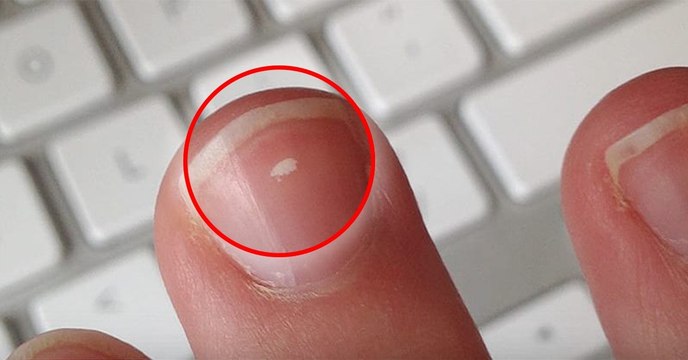 Santé : si vous avez ces marques blanches sur vos ongles, voici pourquoi