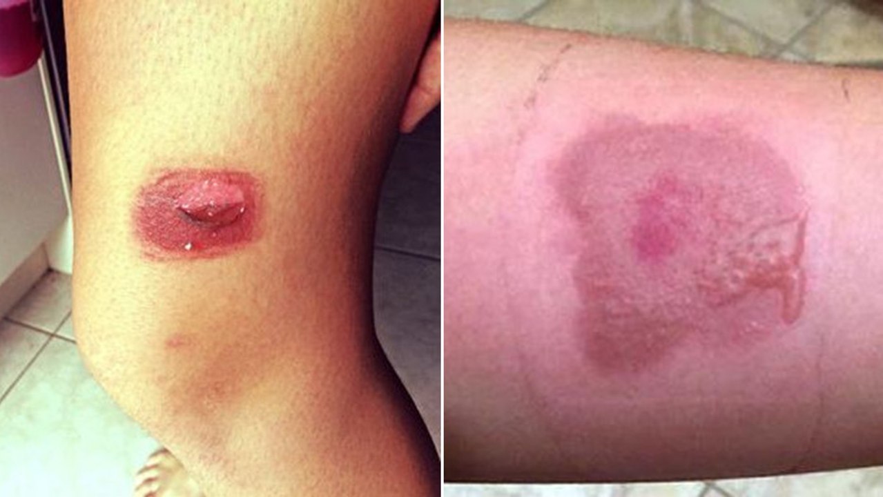 Le 'Salt and ice challenge' : la nouvelle folie des réseaux sociaux qui peut vous coûter très cher