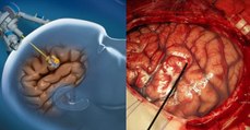 La Keyhole Brain Surgery, une nouvelle technique pour retirer les tumeurs au cerveau