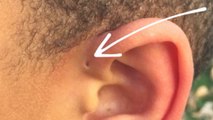Pourquoi certaines personnes ont un trou au-dessus de l'oreille ?