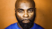 Kaaris : le rappeur publie une photo choc de son visage brûlé quand il était enfant