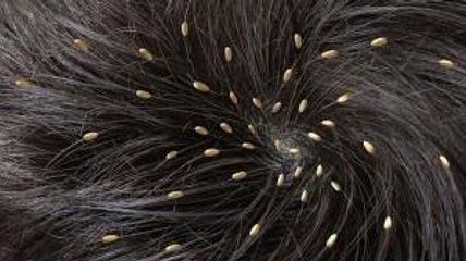 Une femme filmée avec la tête pleine de poux !