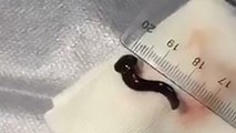 Alors qu'elle sentait quelque chose bloqué dans sa gorge, les médecins retirent un animal (VIDEO)