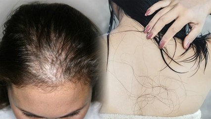 तेजी से बाल झड़ने का कारण Telogen Effluvium Disorder, जल्द आता है गंजापन | Boldsky