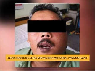 #Bualan 4 Mei: Lelaki masuk ICU letak minyak brek motosikal pada gigi sakit