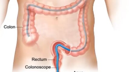 Tips to prevent colorectal cancer