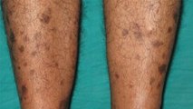पैर में काले धब्बे होने का कारण | पैर पर काले निशान का कारण | Pair Me Kale Dhabbe Hona | Boldsky