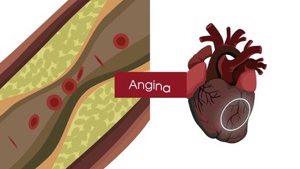 What is a heart attack? | March 15, 2022 | ACM