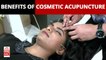 Cosmetic Acupuncture: What are the benefits of it?