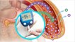 प्री डायबिटीज क्या है | Pre Diabetes Kya Hota Hai | Pre Diabetes Symptoms | Boldsky