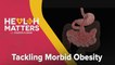 Health Matters with Dishen Kumar: Tackling Morbid Obesity