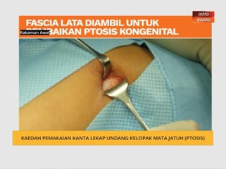 Kaedah pemakaian kanta lekap undang kelopak mata jatuh (Ptosis)