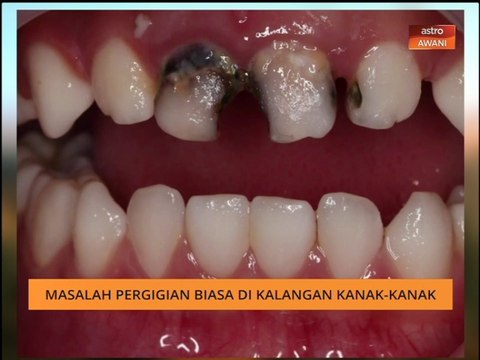 AWANI Pagi - Masalah pergigian biasa di kalangan kanak-kanak
