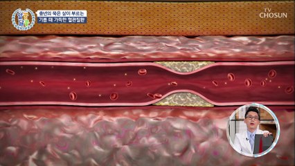 각종 혈관질환과 암까지 부르는 중년의 묵은 살 TV CHOSUN 20220317 방송