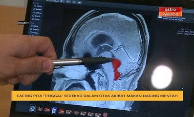Cacing pita 'tinggal' sedekad dalam otak akibat makan daging mentah