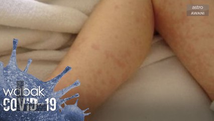 Kanak-kanak positif COVID-19 mungkin menunjukkan gejala berbeza daripada orang dewasa