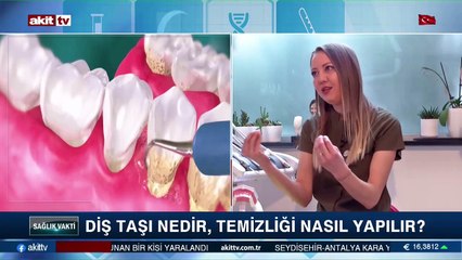 Diş taşı nedir, temizliği nasıl yapılır?