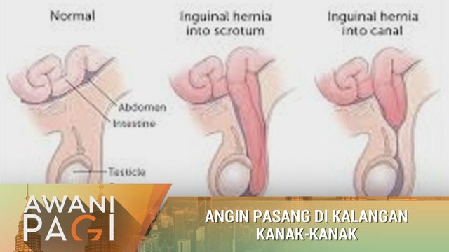 AWANI Pagi: Angin pasang di kalangan kanak-kanak
