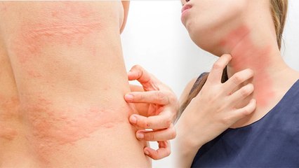 पित्त बढ़ने से शरीर में क्या होता है । पित्त दोष बढ़ने के लक्षण और उपाय । Expert Advice । Boldsky