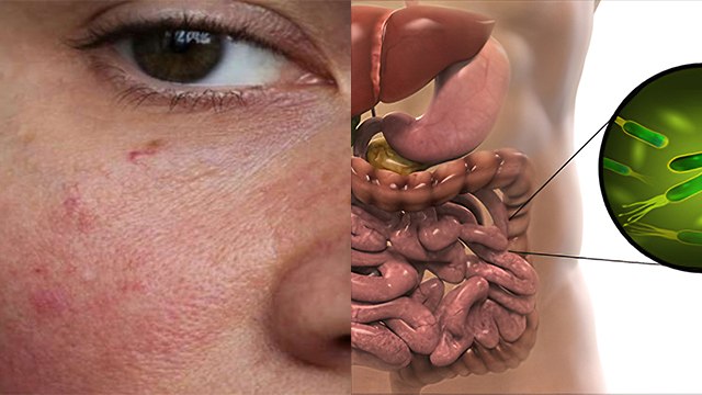 चेहरे पर लाल चकत्ते है पेट में गड़बड़ी का कारण | Pet Me Good Bacteria Kaise Badhaye | Boldsky