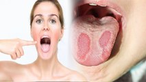 जीभ में  जलन होना Burning Mouth Syndrome Symptoms, क्या हैं बचाव | Boldsky