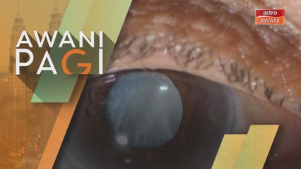 Pendedahan kepada sinaran UV dan faktor usia penyebab utama penyakit katarak mata