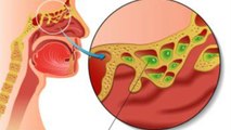 गर्मी में जुकाम होना Sinusitis Symptoms, क्या है Treament | Boldsky